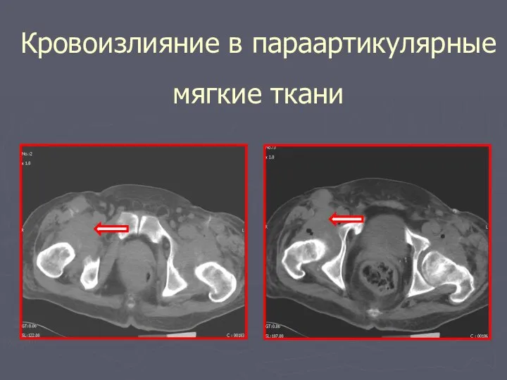 Кровоизлияние в параартикулярные мягкие ткани