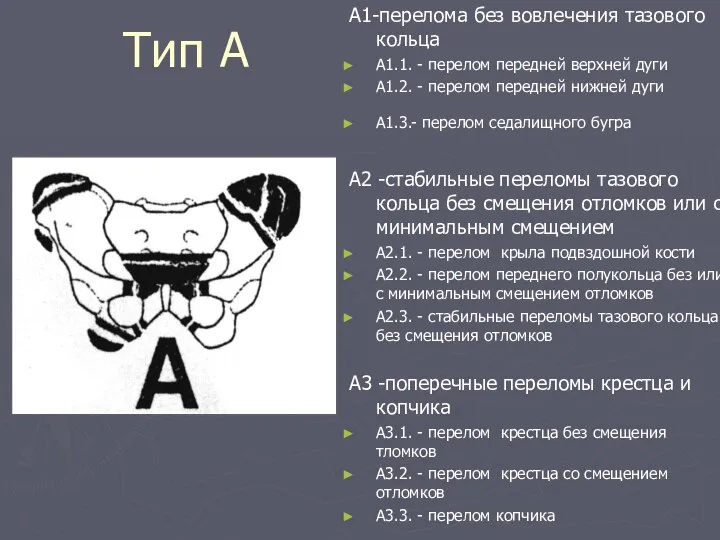 Тип А А1-перелома без вовлечения тазового кольца А1.1. - перелом передней