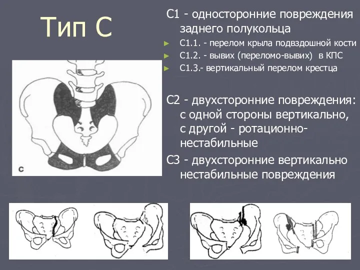 Тип С С1 - односторонние повреждения заднего полукольца С1.1. - перелом