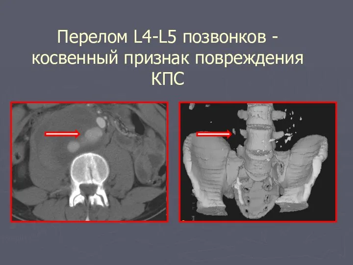 Перелом L4-L5 позвонков -косвенный признак повреждения КПС