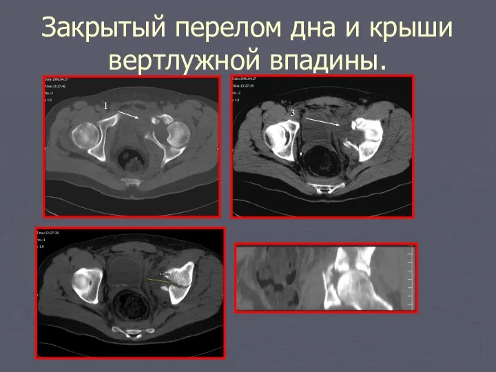 Закрытый перелом дна и крыши вертлужной впадины. 1 3