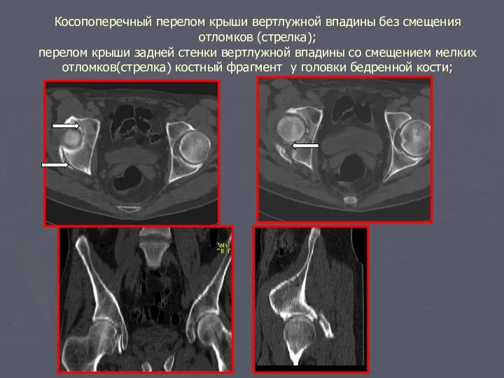 Косопоперечный перелом крыши вертлужной впадины без смещения отломков (стрелка); перелом крыши