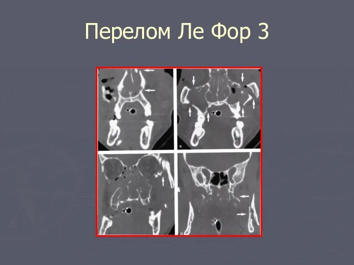 Перелом Ле Фор 3