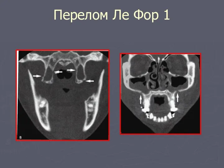 Перелом Ле Фор 1