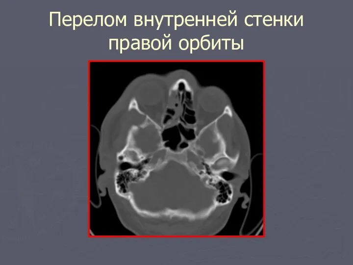 Перелом внутренней стенки правой орбиты