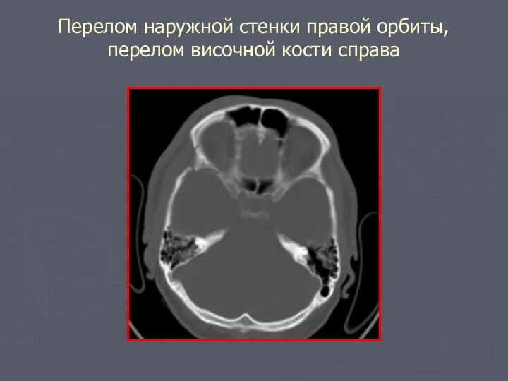 Перелом наружной стенки правой орбиты, перелом височной кости справа