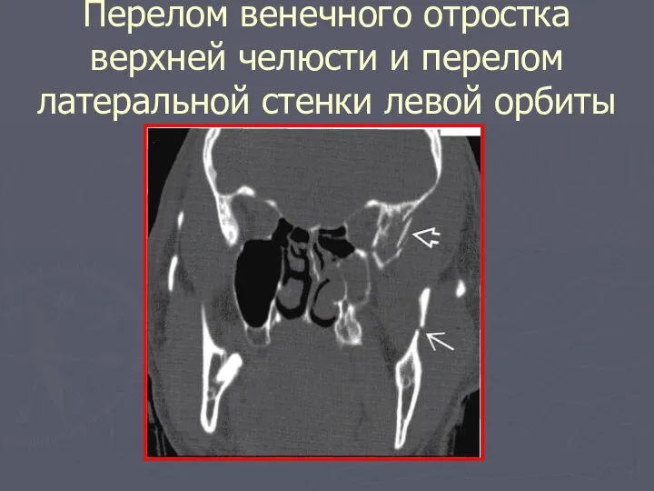 Перелом венечного отростка верхней челюсти и перелом латеральной стенки левой орбиты