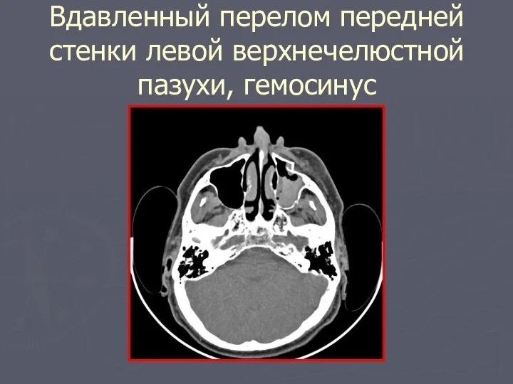 Вдавленный перелом передней стенки левой верхнечелюстной пазухи, гемосинус