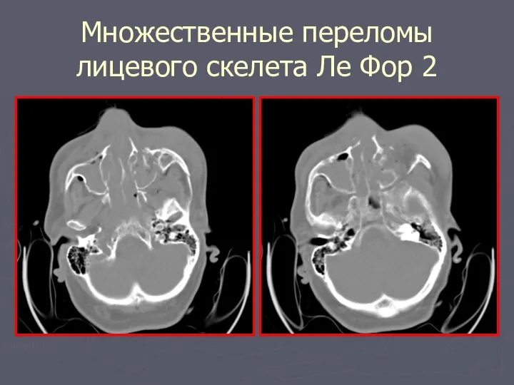 Множественные переломы лицевого скелета Ле Фор 2