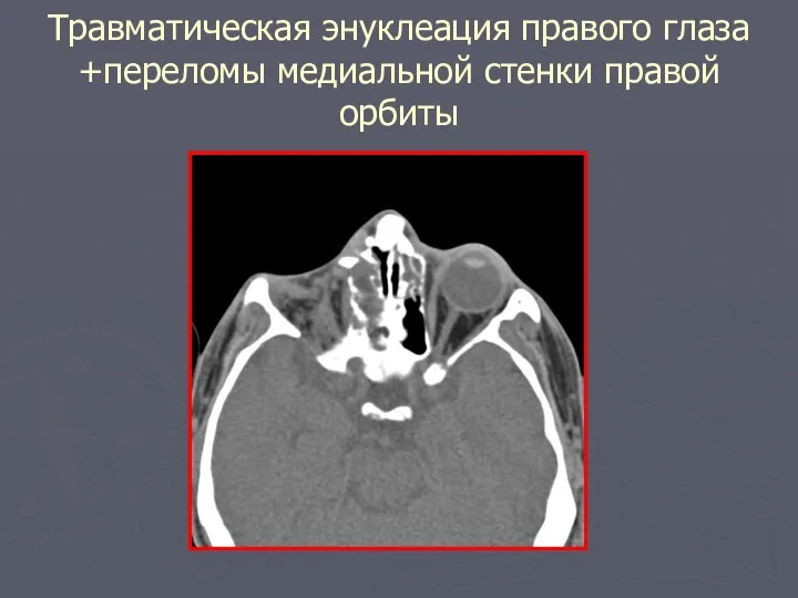 Травматическая энуклеация правого глаза +переломы медиальной стенки правой орбиты