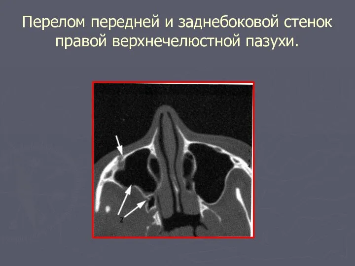 Перелом передней и заднебоковой стенок правой верхнечелюстной пазухи.