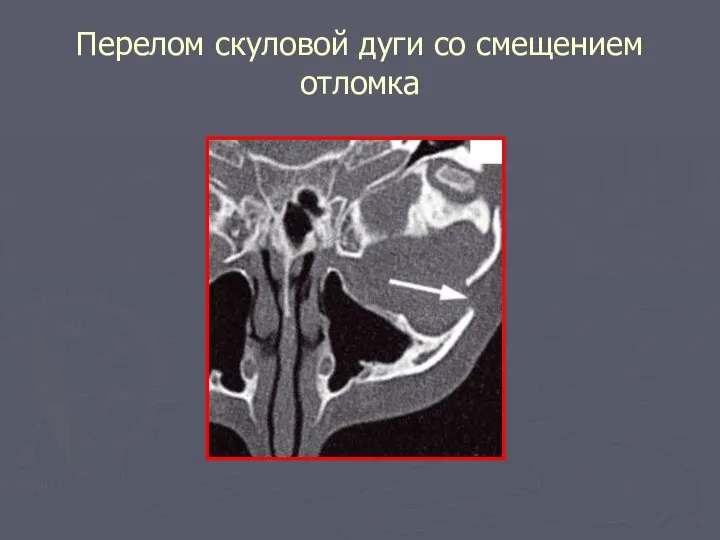 Перелом скуловой дуги со смещением отломка