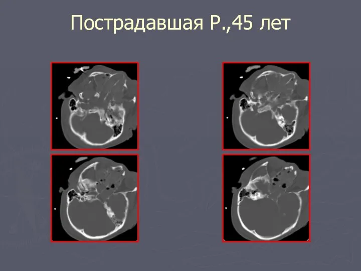 Пострадавшая Р.,45 лет