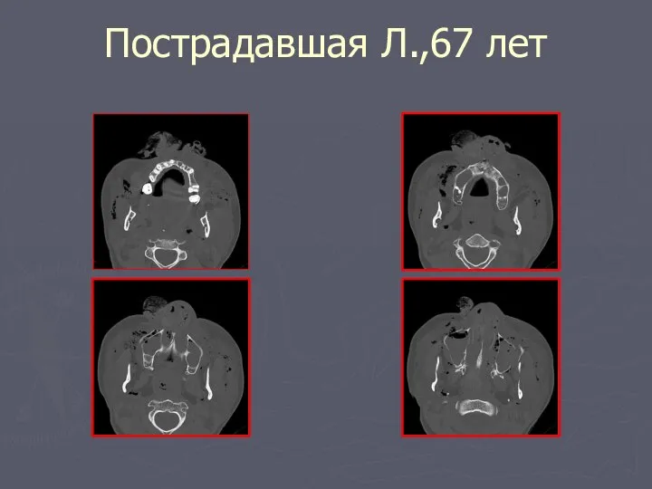 Пострадавшая Л.,67 лет