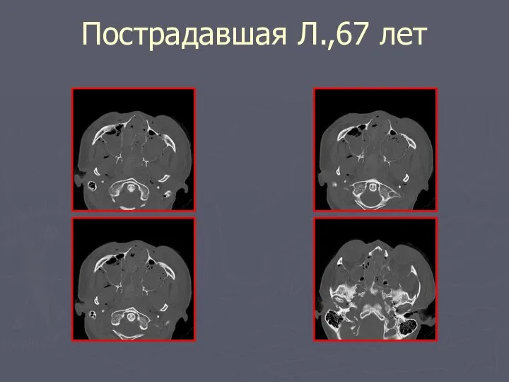 Пострадавшая Л.,67 лет