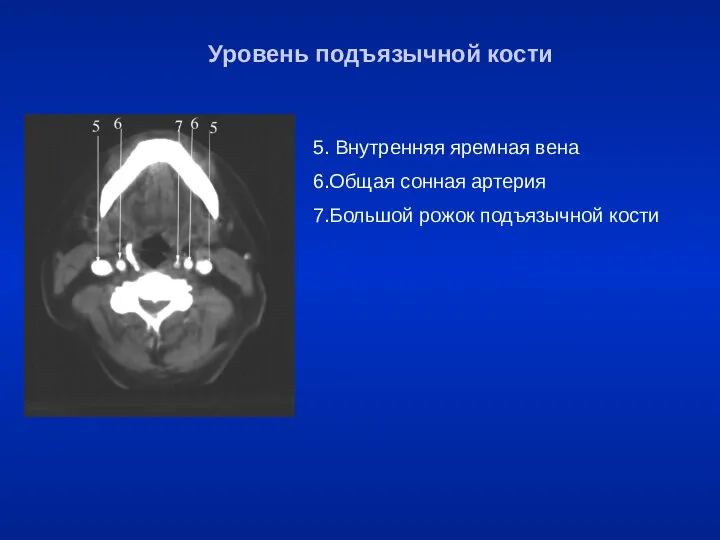 5. Внутренняя яремная вена 6.Общая сонная артерия 7.Большой рожок подъязычной кости Уровень подъязычной кости