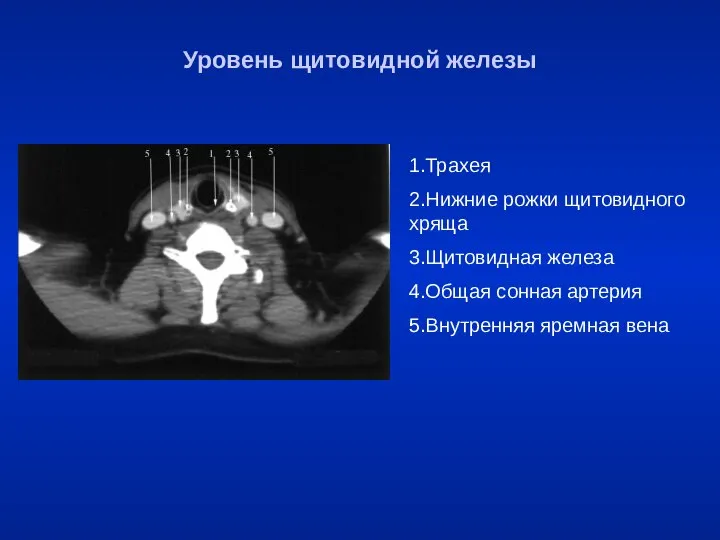 1.Трахея 2.Нижние рожки щитовидного хряща 3.Щитовидная железа 4.Общая сонная артерия 5.Внутренняя яремная вена Уровень щитовидной железы