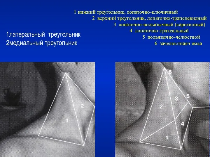 1 нижний треугольник, лопаточно-ключичный 2 верхний треугольник, лопаточно-трапецевидный 3 лопаточно-подьязычный (каротидный)