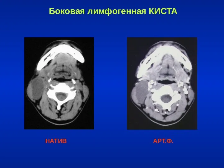 Боковая лимфогенная КИСТА НАТИВ АРТ.Ф.