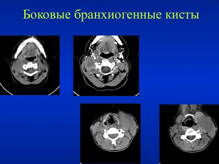 Боковые бранхиогенные кисты