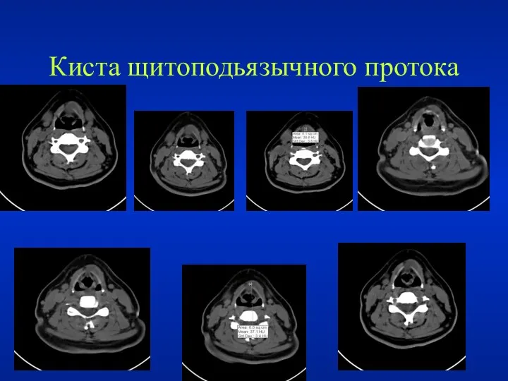 Киста щитоподьязычного протока .