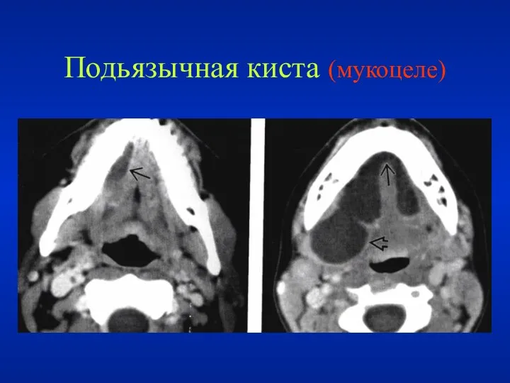 Подьязычная киста (мукоцеле)