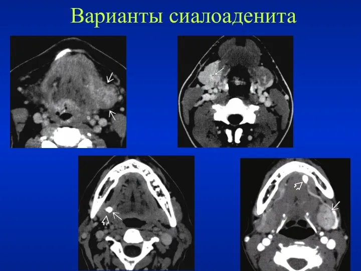 Варианты сиалоаденита