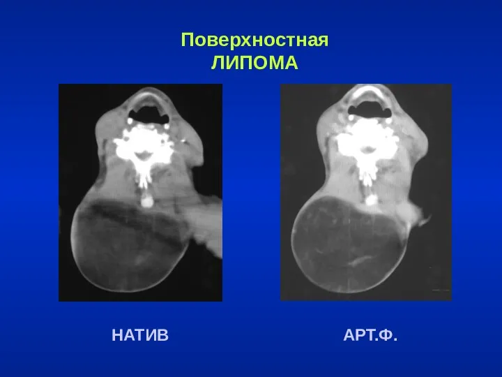 Поверхностная ЛИПОМА НАТИВ АРТ.Ф.