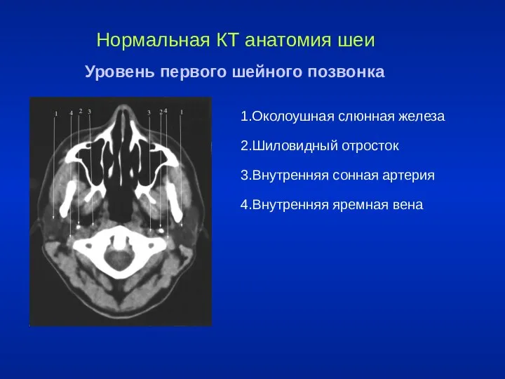 Нормальная КТ анатомия шеи Уровень первого шейного позвонка 1.Околоушная слюнная железа