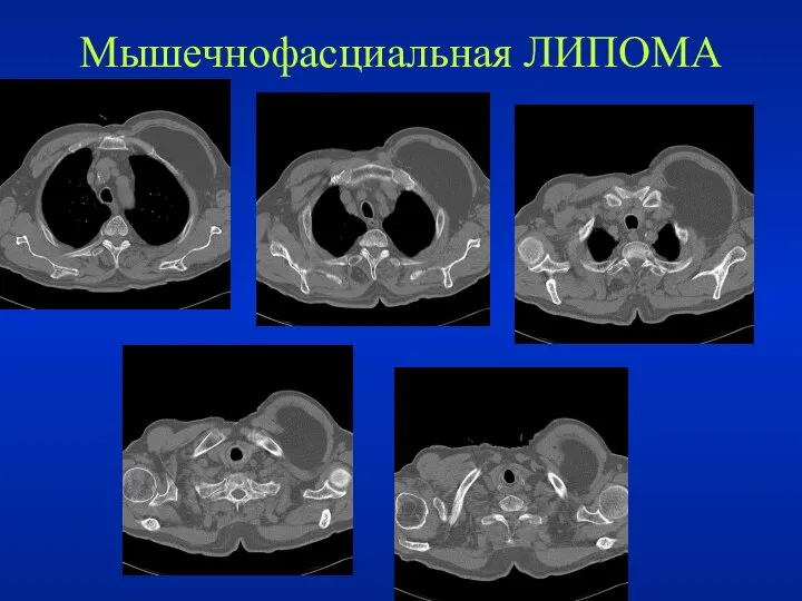 Мышечнофасциальная ЛИПОМА .