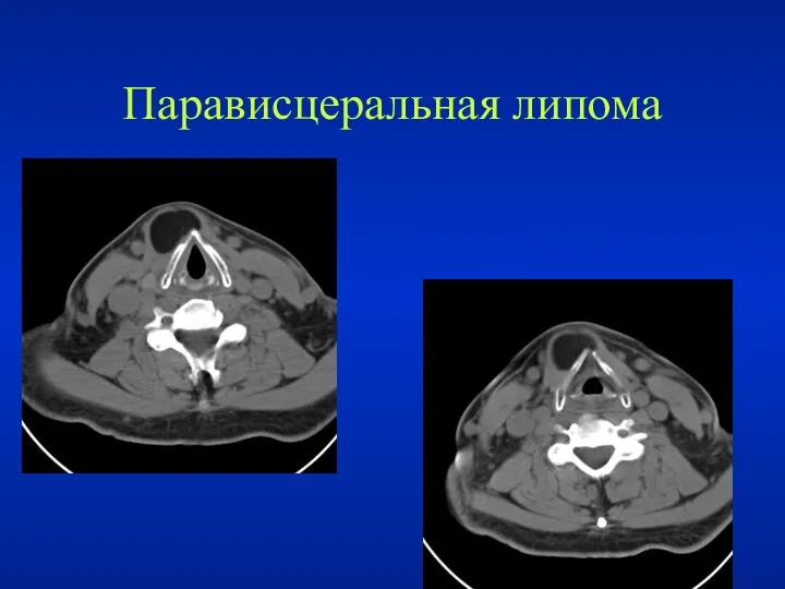 Парависцеральная липома