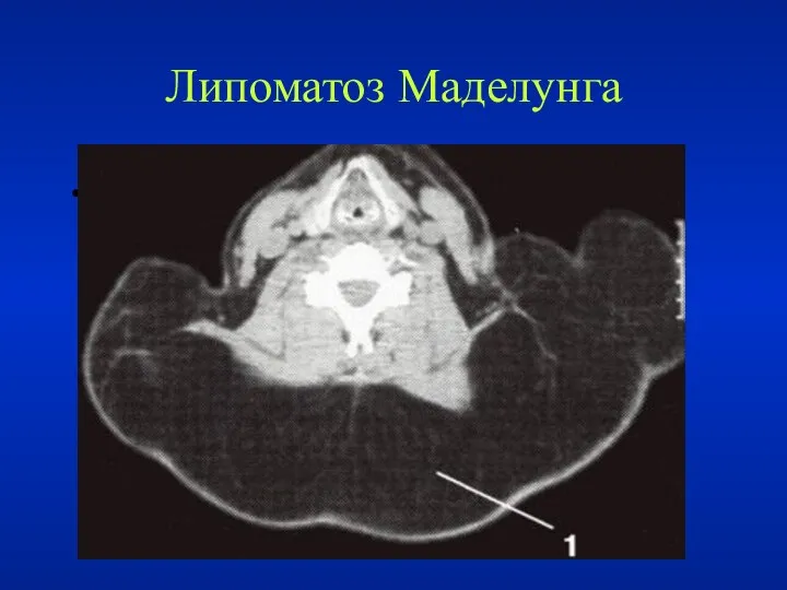 Липоматоз Маделунга .