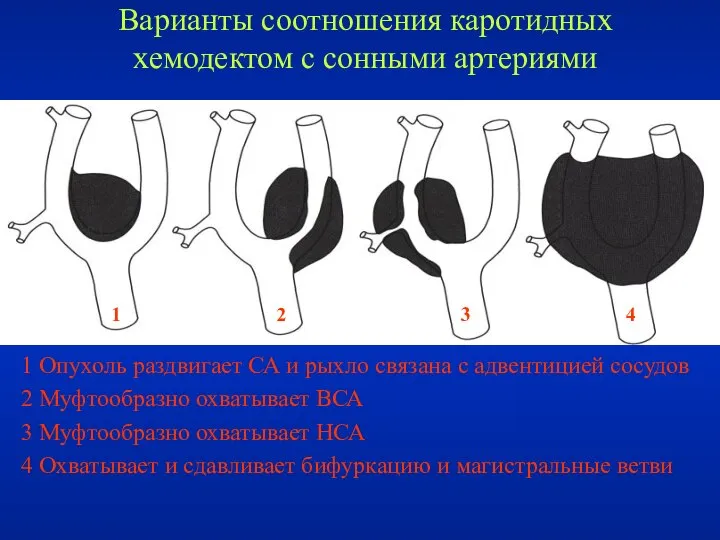 Варианты соотношения каротидных хемодектом с сонными артериями 1 Опухоль раздвигает СА