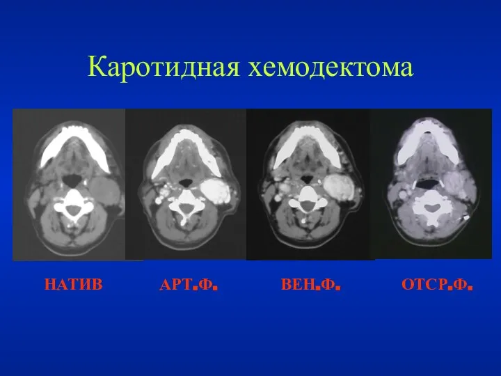 НАТИВ АРТ.Ф. ВЕН.Ф. ОТСР.Ф. Каротидная хемодектома