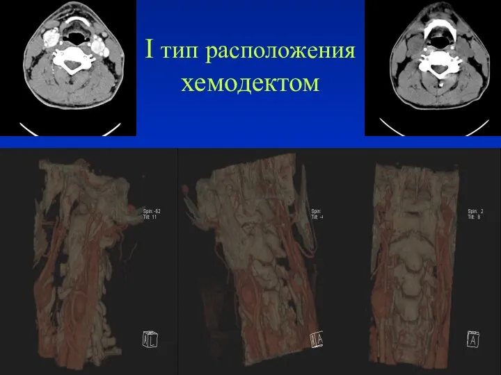 I тип расположения хемодектом