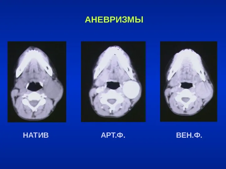 АНЕВРИЗМЫ НАТИВ АРТ.Ф. ВЕН.Ф.