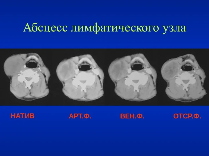 НАТИВ АРТ.Ф. ВЕН.Ф. ОТСР.Ф. Абсцесс лимфатического узла