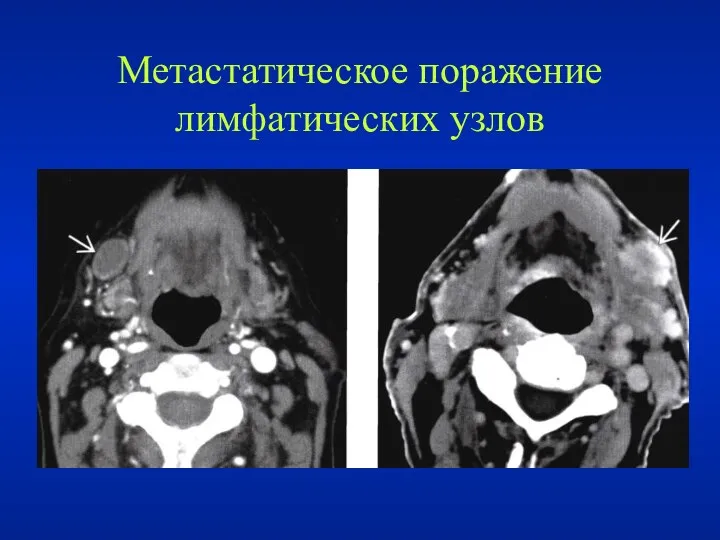 Метастатическое поражение лимфатических узлов