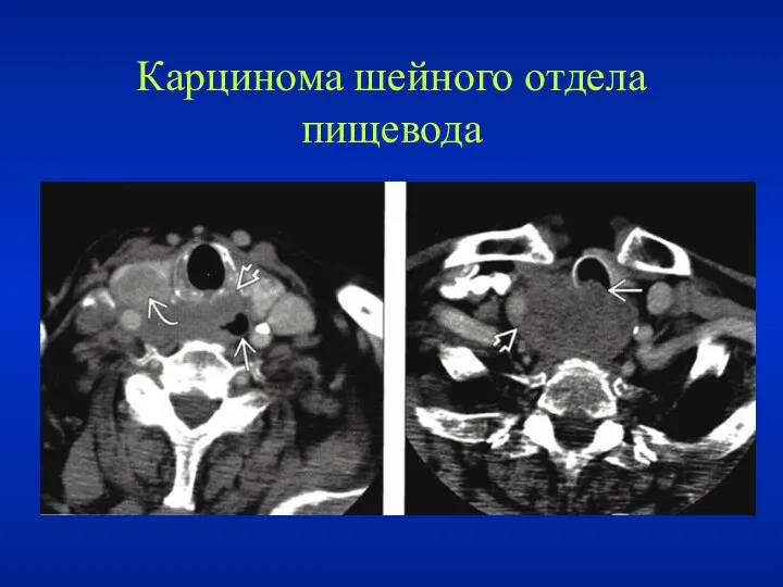 Карцинома шейного отдела пищевода