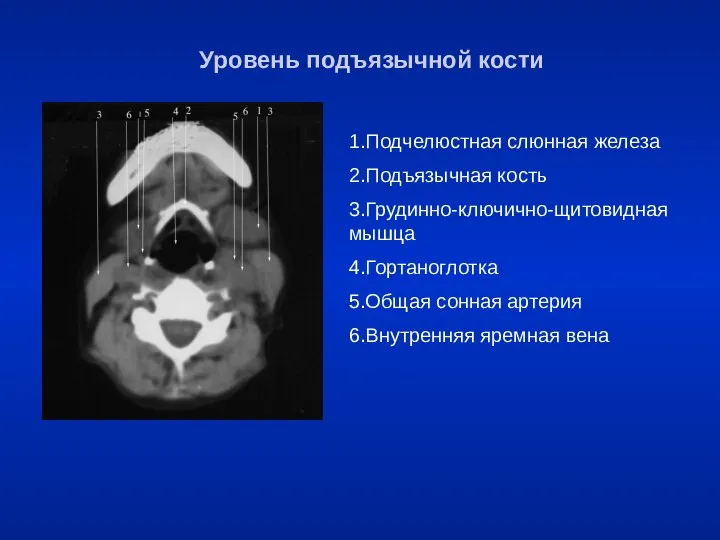 Уровень подъязычной кости 1.Подчелюстная слюнная железа 2.Подъязычная кость 3.Грудинно-ключично-щитовидная мышца 4.Гортаноглотка