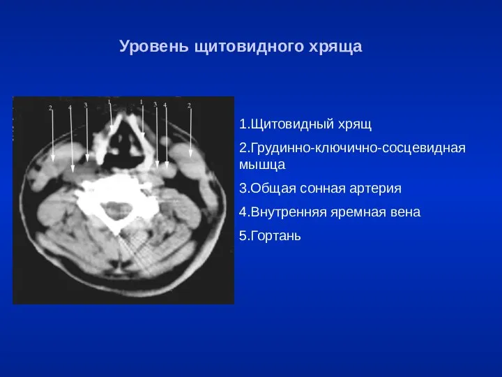 Уровень щитовидного хряща 1.Щитовидный хрящ 2.Грудинно-ключично-сосцевидная мышца 3.Общая сонная артерия 4.Внутренняя яремная вена 5.Гортань