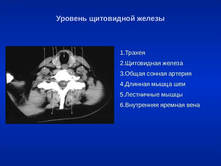 Уровень щитовидной железы 1.Трахея 2.Щитовидная железа 3.Общая сонная артерия 4.Длинная мышца