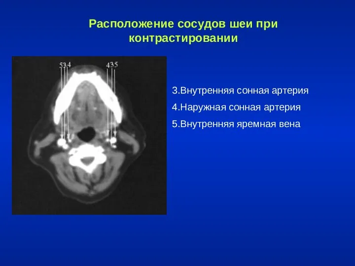 Расположение сосудов шеи при контрастировании 3.Внутренняя сонная артерия 4.Наружная сонная артерия 5.Внутренняя яремная вена