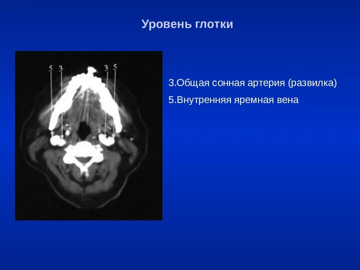 3.Общая сонная артерия (развилка) 5.Внутренняя яремная вена Уровень глотки