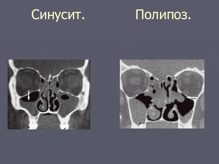 Синусит. Полипоз.