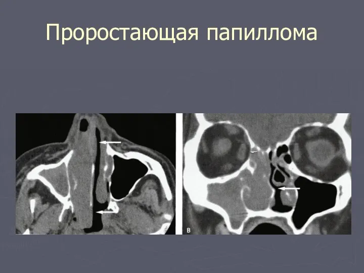 Проростающая папиллома