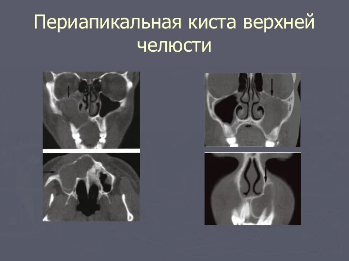 Периапикальная киста верхней челюсти