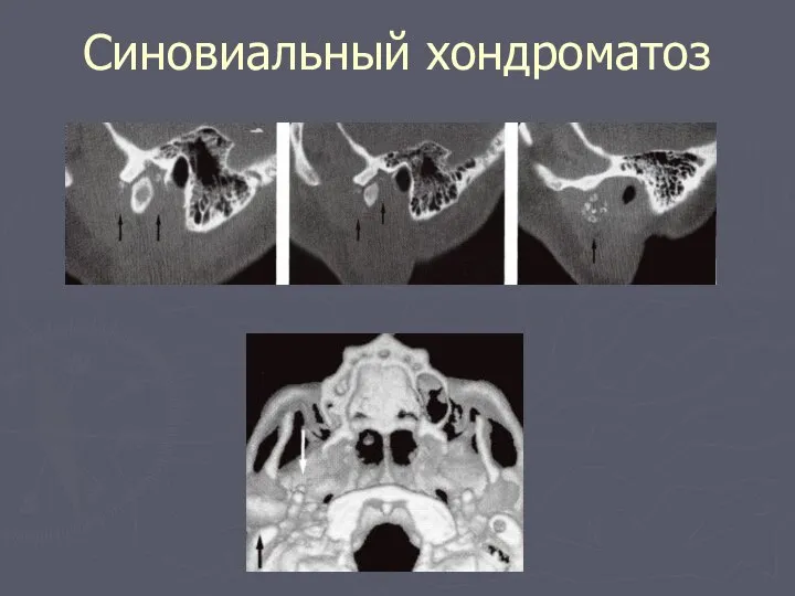 Синовиальный хондроматоз