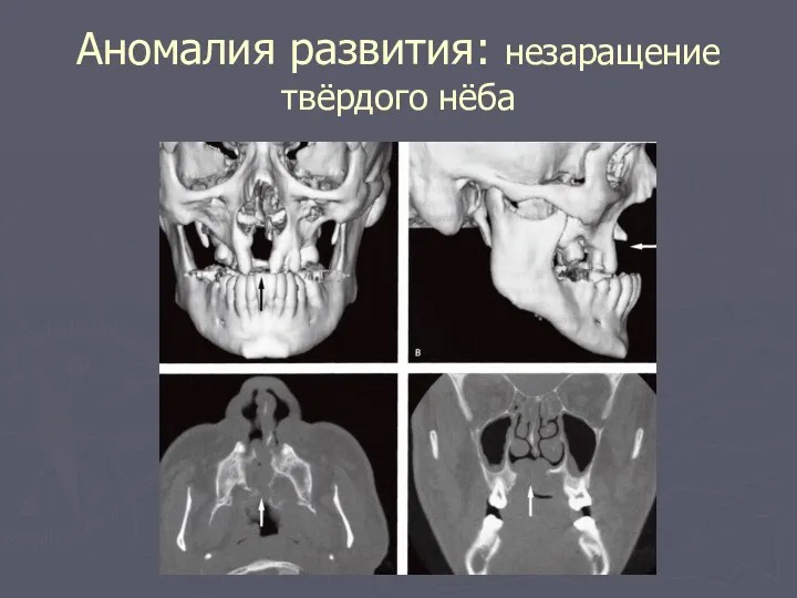 Аномалия развития: незаращение твёрдого нёба