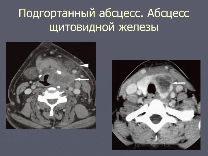 Подгортанный абсцесс. Абсцесс щитовидной железы